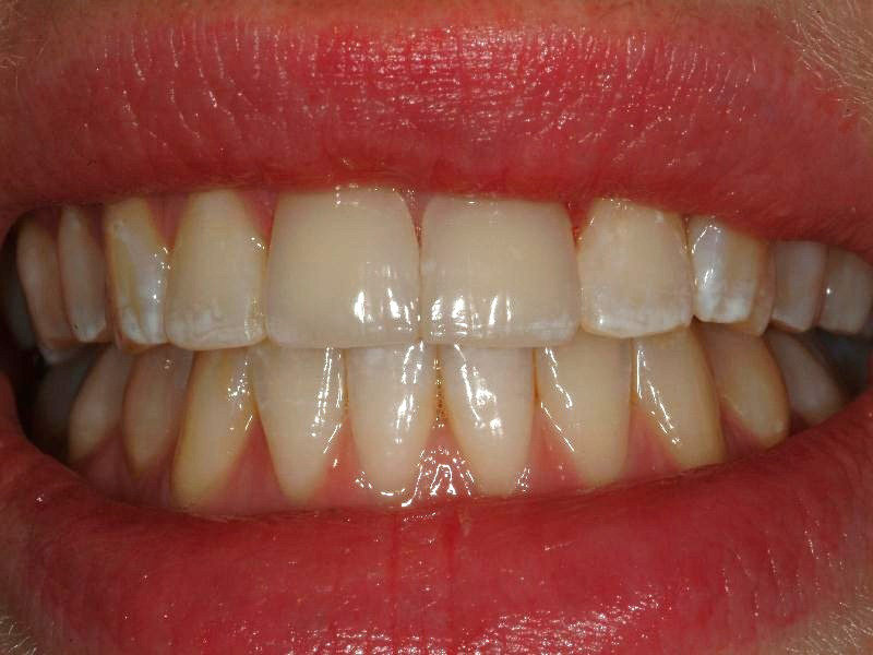 After veneers treatment