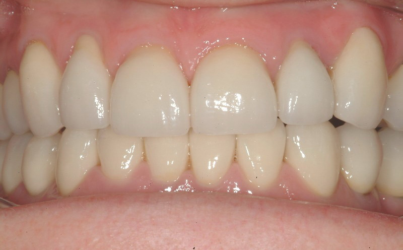 After veneers treatment