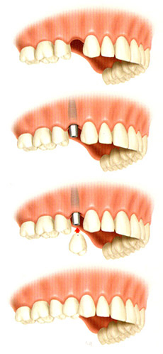 Dental Implants