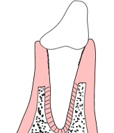 After periodontitis treatment