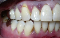 Inflamed gums