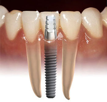 Dental Implant