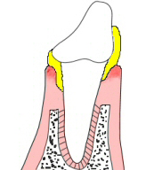 Before periodontitis treatment