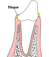 Plaque on tooth