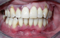 Red swollen gums