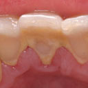 Dental tartar